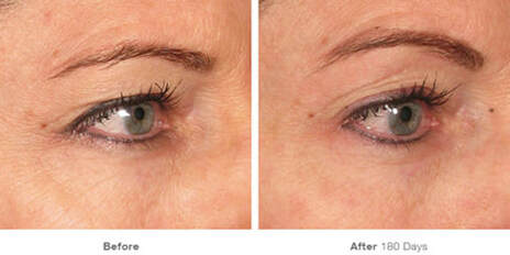 Ultherapy before and after 180 days eye pics