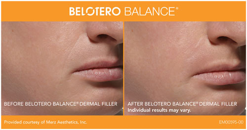 Belotero before and after male