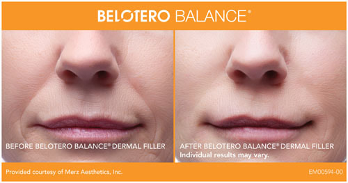 Belotero before and after female