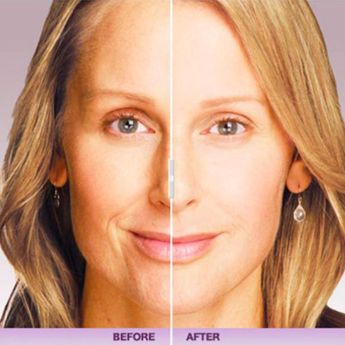 Juvederm Voluma XC before and after