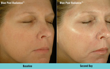 Radiance Peel before and after second day