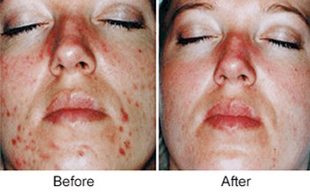 Radiance Peel before and after
